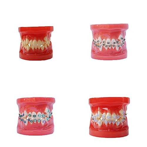Fogat modell fogászati modell fogorvos patológia modell laboratóriumi kutatás, tanulás használja (Teljes kerámia bracket)